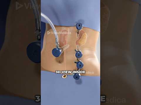 Robot Assisted Human Kidney Removal 3D Animation Robot Assisted Human Kidney Removal 3D Animation
