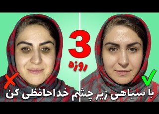  Remove Your Dark Under Eye Circles In 3 Days رفع تیرگی زیر چشم فقط در سه روز