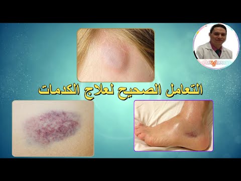 علاج الكدمات Iوطرق التعامل معها بطريقة بسيطه علاج الكدمات Iوطرق التعامل معها بطريقة بسيطه