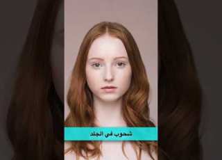 فقر الدم بنقص الحديد بدقيقة واحدة