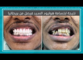 نتيجة ابتسامة هوليود للسيد فيصل من بريطانيا
