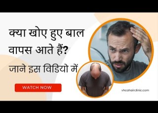 क य ख ए ह ए ब ल व पस आत ह Hair Loss Treatment Hair Fall Solution VHCA Hair Clinic