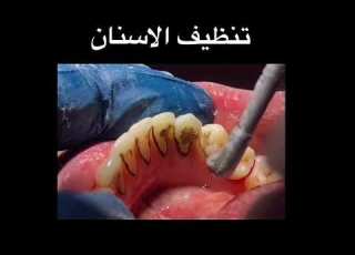  تنظيف جير الاسنان