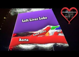 Celiac Artery Compression Syndrome Ultrasound