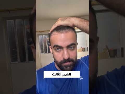 زراعة الشعر من اول يوم لاخر يوم