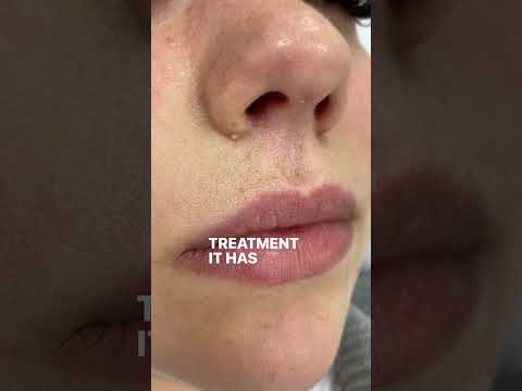 Milia Removal Treatment Before After Advancedelectrolysis Skincare Miliaremoval