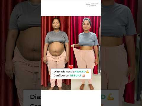 17 Kg Weight Loss And Belly Fat Gone Diastasis Recti Healed MyHealthBuddy
