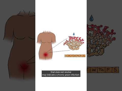 احصل على الراحة من عدوى الخميرة المزمنة