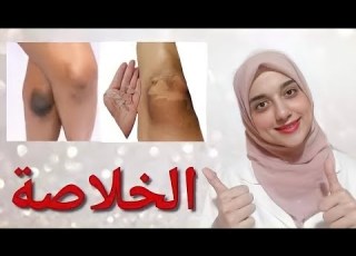  تفتيح وتقشير الركب و الأكواع في ٣ أيام فقط بأقل التكاليف والتخلص من الإسمرار والسواد نهائيا