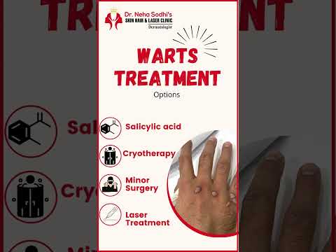WARTS Treatment