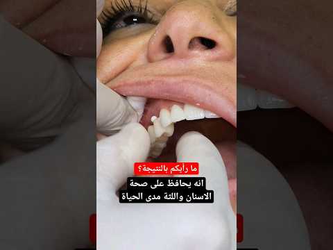 تركيب اسنان وجسور زيركون بعد ترميم كامل الاسنان والنتيجة ابتسامة جميلة صحية