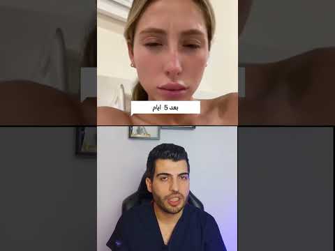 تأثير حقن البوتوكس ع الوجه حقن بوتكس حقن الفيلر بوتوكس بوتوكس فيلر ديرمارولر النساء د مصعب حسوا