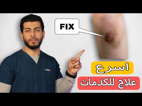 Treating Bruises Home Remedies For Blue And Swollen Bruises On The Body Treating Bruises On T Treating Bruises Home Remedies For Blue And Swollen Bruises On The Body Treating Bruises On T