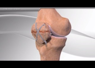 Patella Fracture Repair