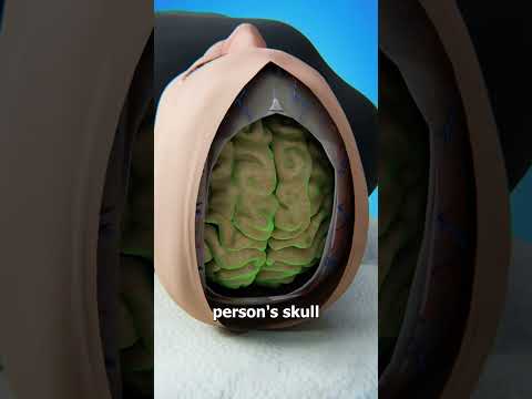 Is It Possible To Swap Brains