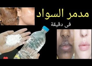 عشرينيه تقسم نصحنى به طبيب جزائري كان وجهي مدمر سواد والتهاب أصبح ابيض من الثلج وكل من رأى وجهي تعجب