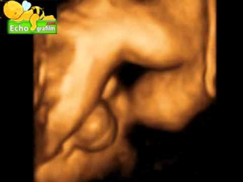 Echographie 3D Sexe Masculin C Est Un Garcon