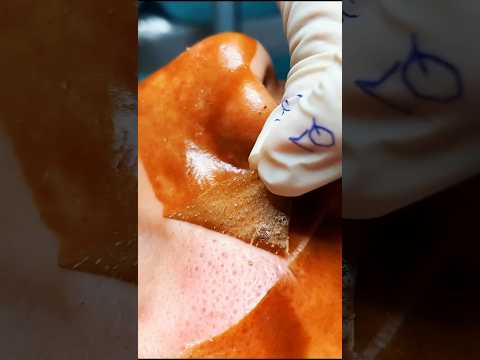 Remove Open Pores Naturally Best Home Remedy Shorts Youtubeshorts Skincare Remove Open Pores Naturally Best Home Remedy Shorts Youtubeshorts Skincare