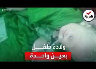 حالة نادرة ولادة طفل يمني بعين واحدة