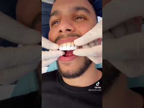 شرح لابتسامة هوليوود المتحركة Snap On Smile