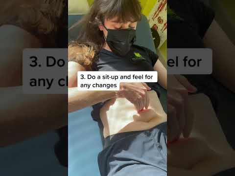 How Do I Know If I Have Diastasis Recti