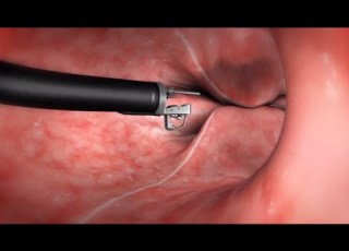 What Happens During The Endoscopic Sleeve Gastroplasty ESG Procedure