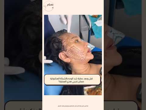 قبل وبعد عملية شد الوجه بالشبكة العنكبوتية تقنية حديثة لشد الوجه بدون اثار جانبية اكسبلور السعودية