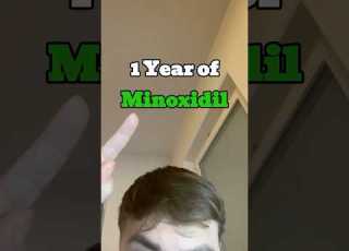  This Is What 1 Year Of Minoxidil Looks Like Month For Month