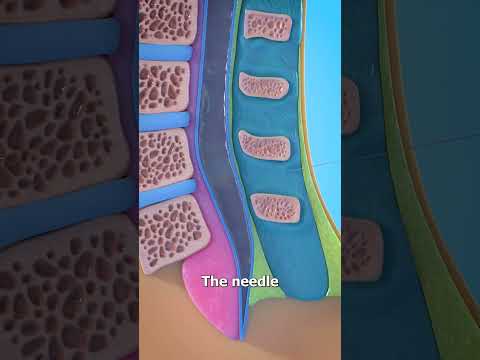How A Spinal Tap Works