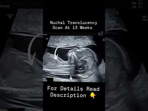 NT Scan At 13 Weeks Of Pregnancy Nuchal Translucency Scan