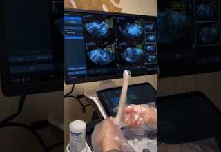 مراحل سونوگرافی واژینال جهت رویت قلب جنین ومشکلات رحمی سونوگرافی واژینال دکتر ابراهیمی سونوگرافی