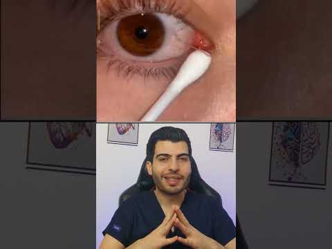 صحة العين متلازمة الصيد المخاطي العين التهاب التهاب العين صحة العين د مصعب حسوا يوتيوب