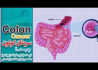  چطور می توان جلو مرگ و میر سرطان کولون را گرفت