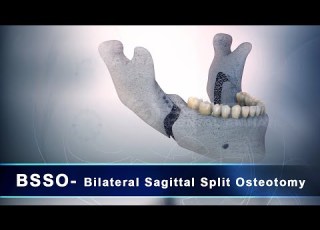BSSO Bilateral Sagittal Splitting Osteotomy 3D Dental Animation