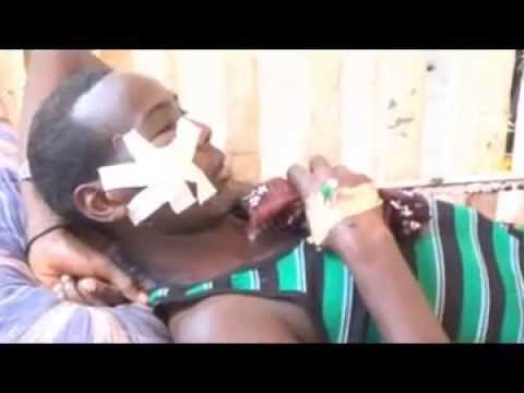 Dhaawacyadda Maatida Habargidir Iyo Mareexaan Part 3