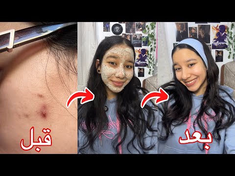 اقوي ماسك للحبوب والتصبغات واثار الحبوب الحبوب هتختفي في يوم واحد فقط تجهيزات العيد