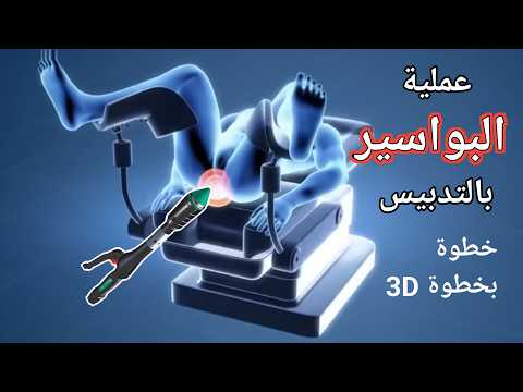 شرح عملية البواسير بالتدبيس خطوة بخطوة 3D رحلة علاج البواسير نهائيا دروس طبية