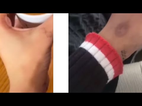 كريم سحري شوفوا اخر الفديو كيف ازال الحروق