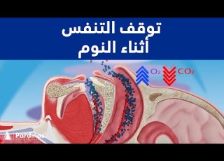  توقف التنفس أثناء النوم