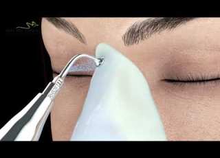 أحدث جهاز لتجميل الأنف في الشرق الأوسط جهاز بيزو Piezo دكتور جمال جمعه استشاري جراحة التجميل