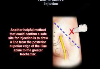 حقن المؤخرة حقن الأرداف