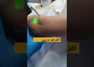 اجدد جهاز ليزر لازالة الشعر من ديكا الشارقة Clinicdubai Lasertattooremoval ليزر ازالة شعر