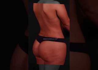  360 Liposuction And Brazillian Butt Lift BBL L Plastic Surgery Shorts Aestheticsurgeon
