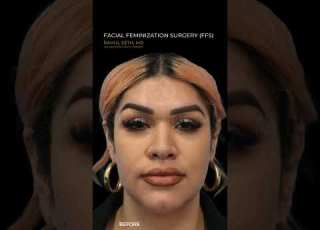 Before After Facial Feminization Surgery