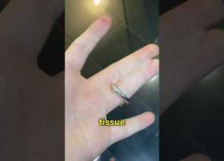  When Fingers Grow Together