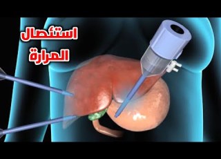 شاهد عملية إزالة المرارة Gallbladder Removal Surgery And Laparoscopy