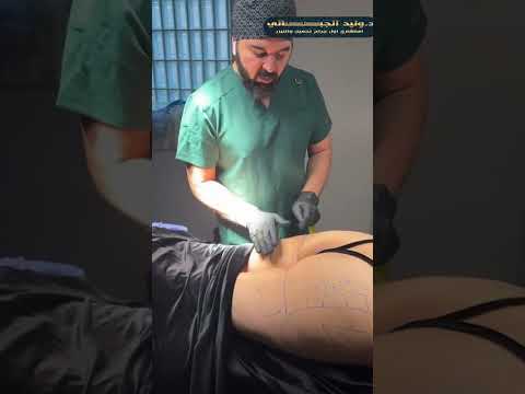 Today We Have A Butt Lift Waist Sculpting And Back Lift Procedure Wait A Little Longer For The