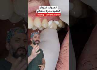الحشوات الملغمي ة مضر ة لصح تكم لذا الأفضل إزالتها Dentist Fyp Shorts