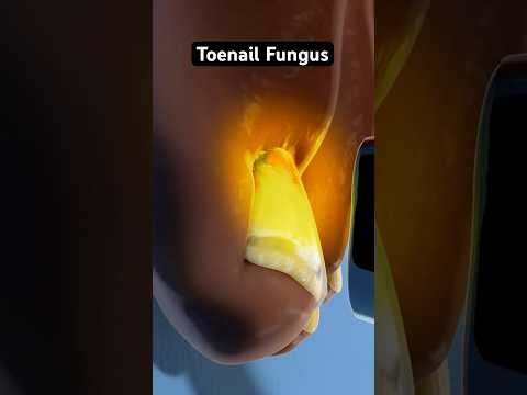 Eliminating Persistent Toenail Fungus 3D Animation