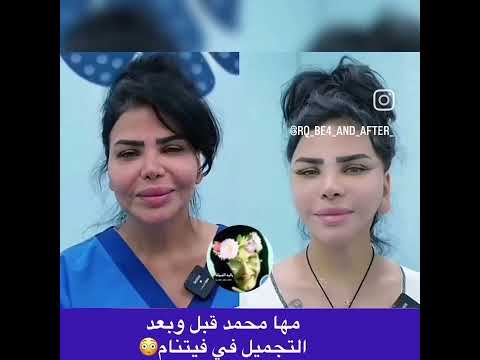 مها محمد بعد عملية تجميل فيتنام